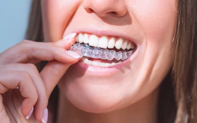 Invisalign Treatment Process: What to Expect from Beginning to End